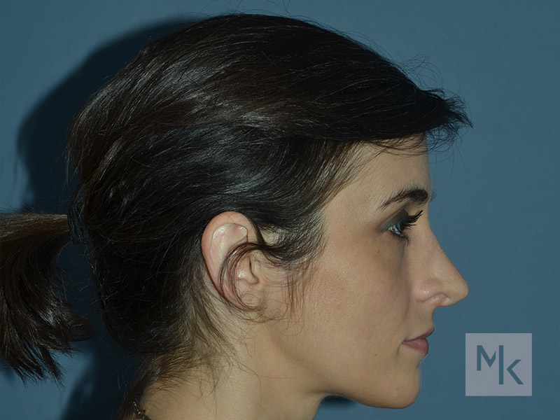 Rhinoplasty Revision Before and After | Dr. Michael Kim