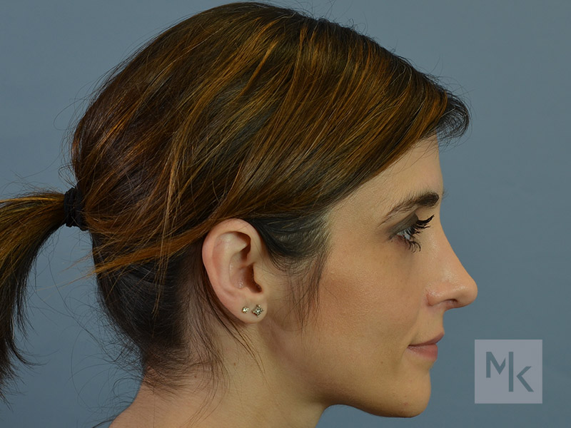 Rhinoplasty Revision Before and After | Dr. Michael Kim