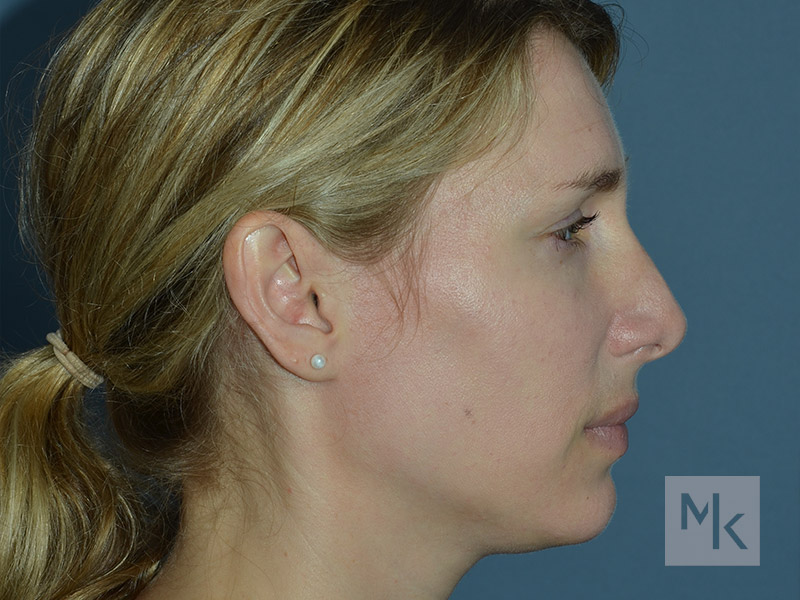 Rhinoplasty Revision Before and After | Dr. Michael Kim