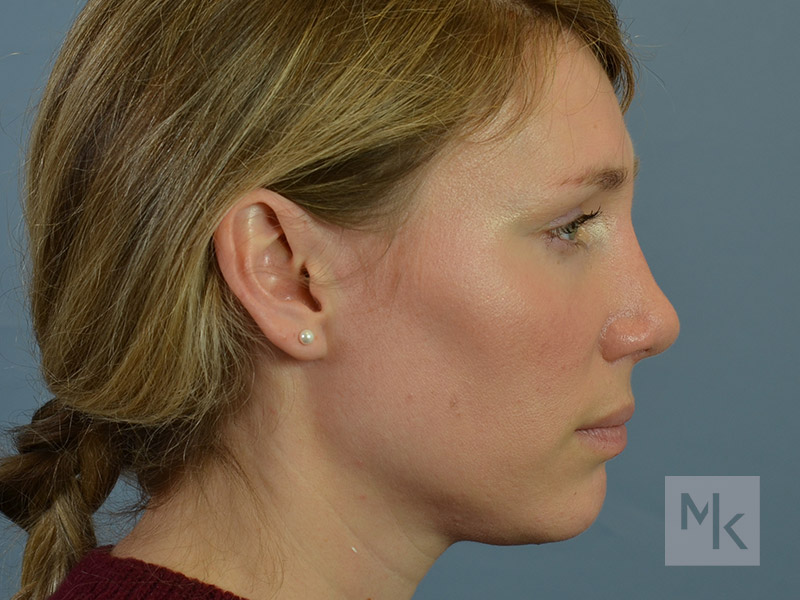 Rhinoplasty Revision Before and After | Dr. Michael Kim