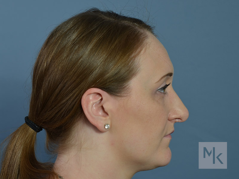 Rhinoplasty Revision Before and After | Dr. Michael Kim