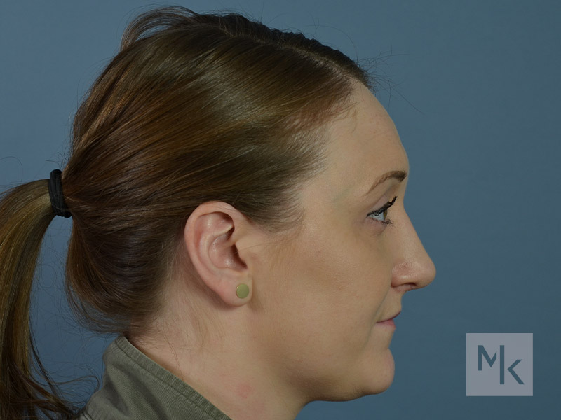 Rhinoplasty Revision Before and After | Dr. Michael Kim