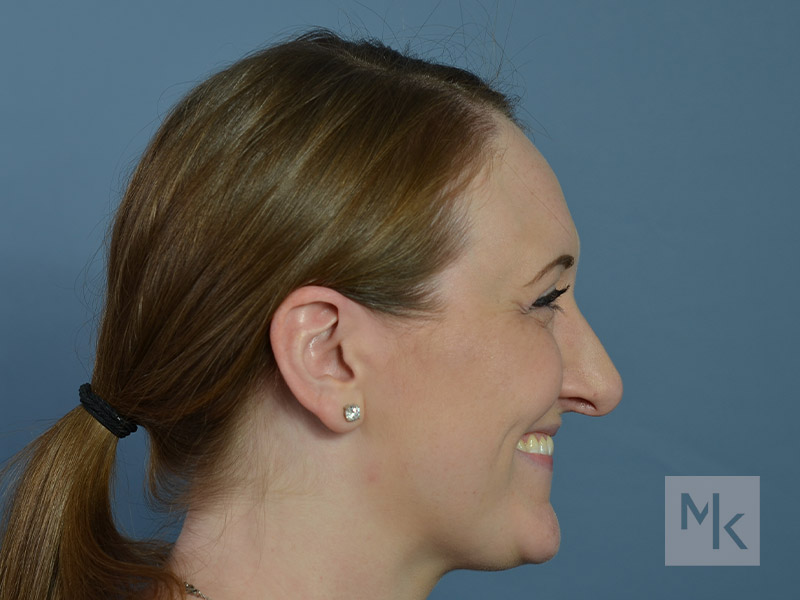 Rhinoplasty Revision Before and After | Dr. Michael Kim