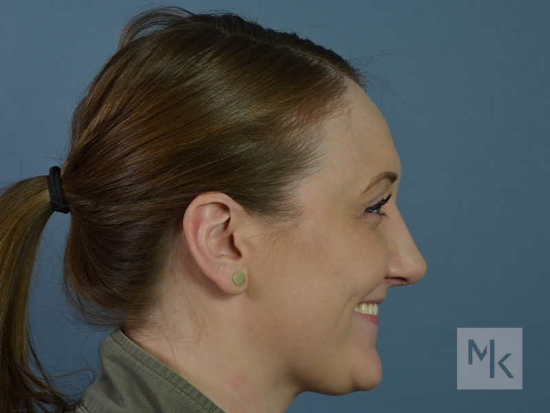 Rhinoplasty Revision Before and After | Dr. Michael Kim