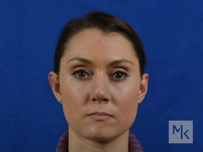 Rhinoplasty Revision Before and After | Dr. Michael Kim