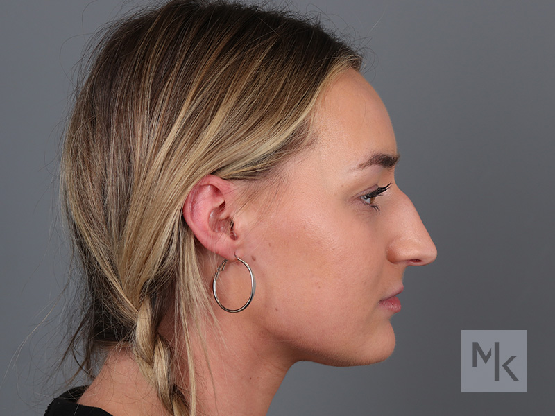 Rhinoplasty Before and After | Dr. Michael Kim