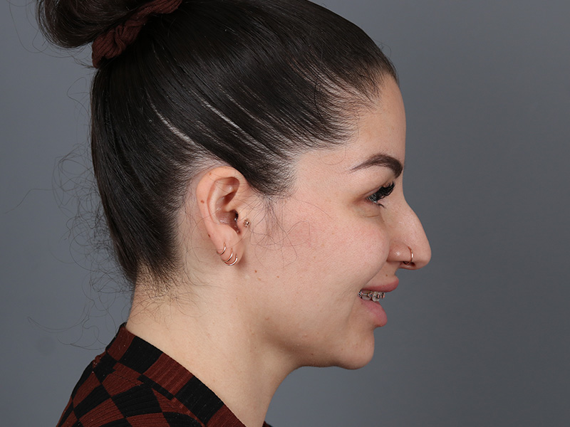 Rhinoplasty Before and After | Dr. Michael Kim