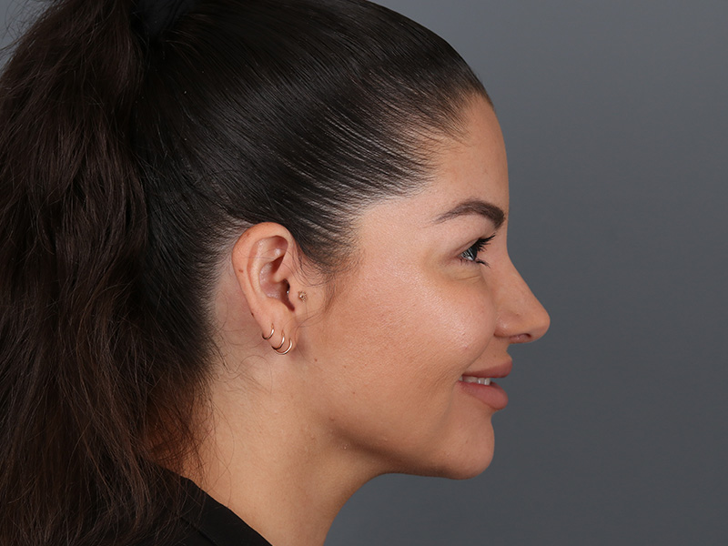 Rhinoplasty Before and After | Dr. Michael Kim