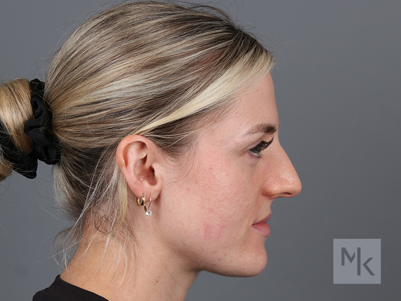 Rhinoplasty Before and After | Dr. Michael Kim