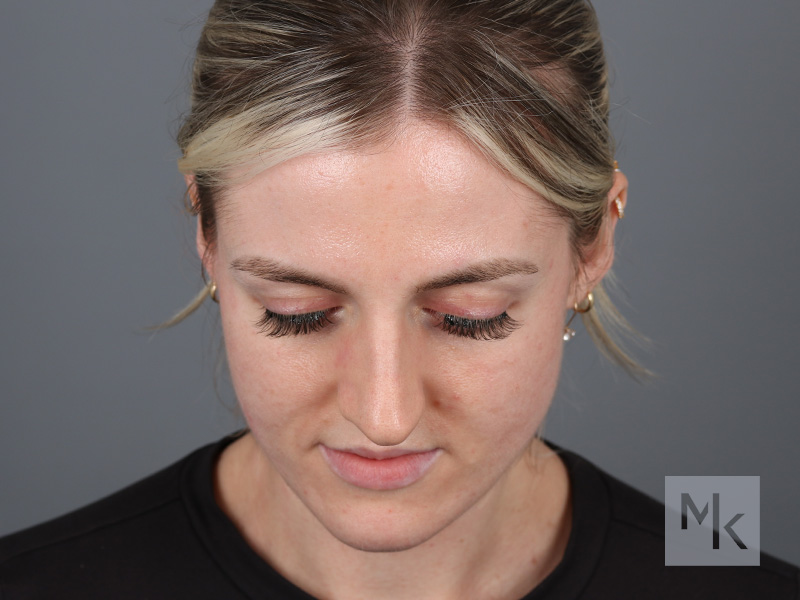 Rhinoplasty Before and After | Dr. Michael Kim