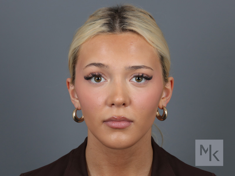 Rhinoplasty Before and After | Dr. Michael Kim