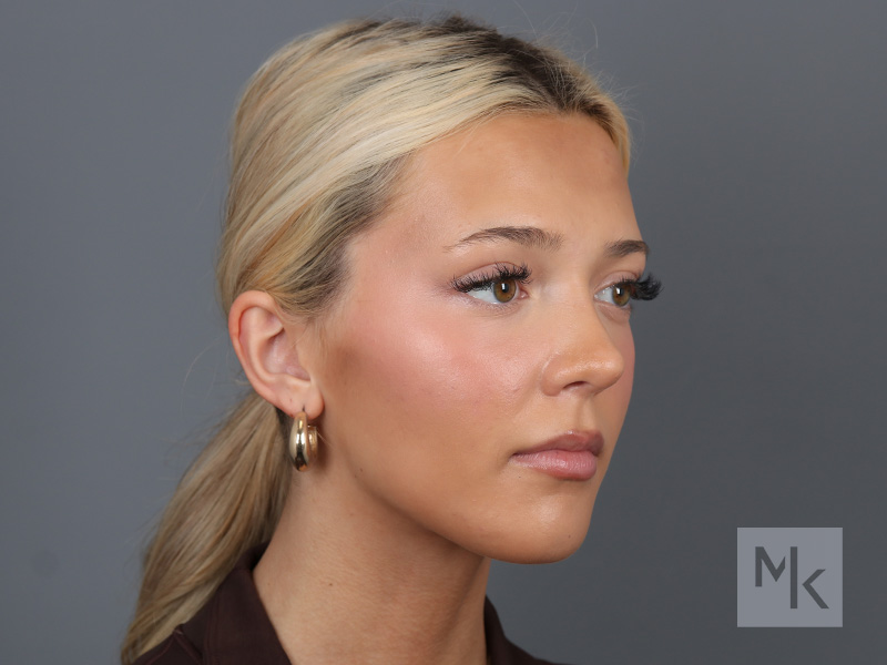 Rhinoplasty Before and After | Dr. Michael Kim