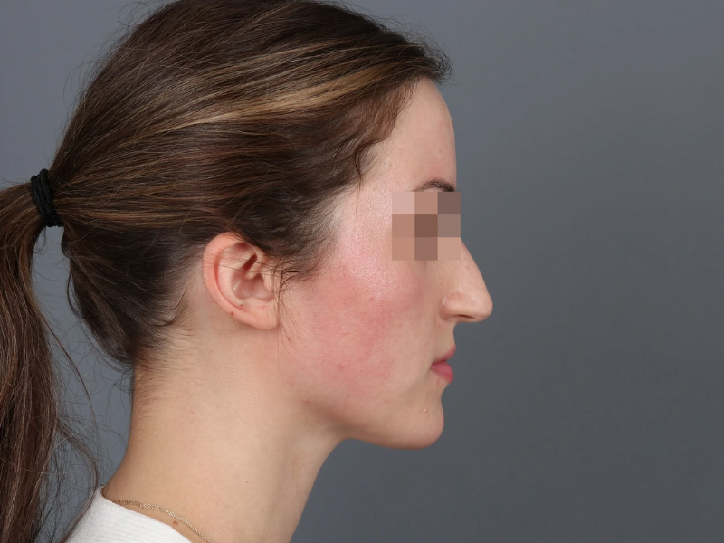 Rhinoplasty Before and After | Dr. Michael Kim