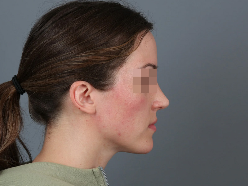 Rhinoplasty Before and After | Dr. Michael Kim