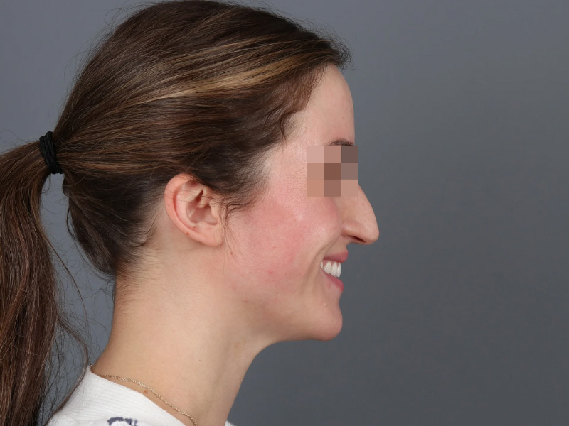 Rhinoplasty Before and After | Dr. Michael Kim