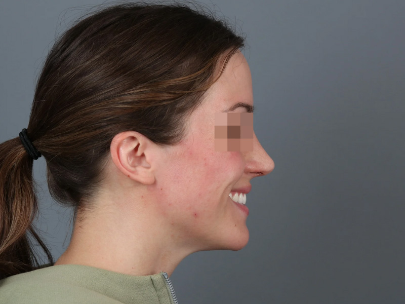 Rhinoplasty Before and After | Dr. Michael Kim