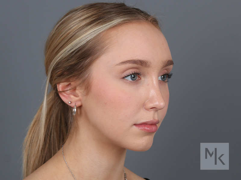 Rhinoplasty Before and After | Dr. Michael Kim