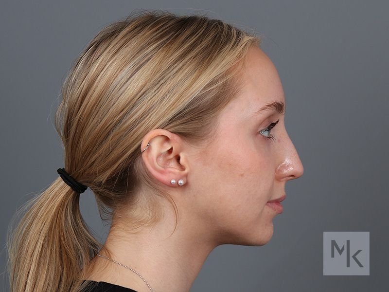 Rhinoplasty Before and After | Dr. Michael Kim