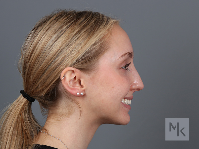 Rhinoplasty Before and After | Dr. Michael Kim