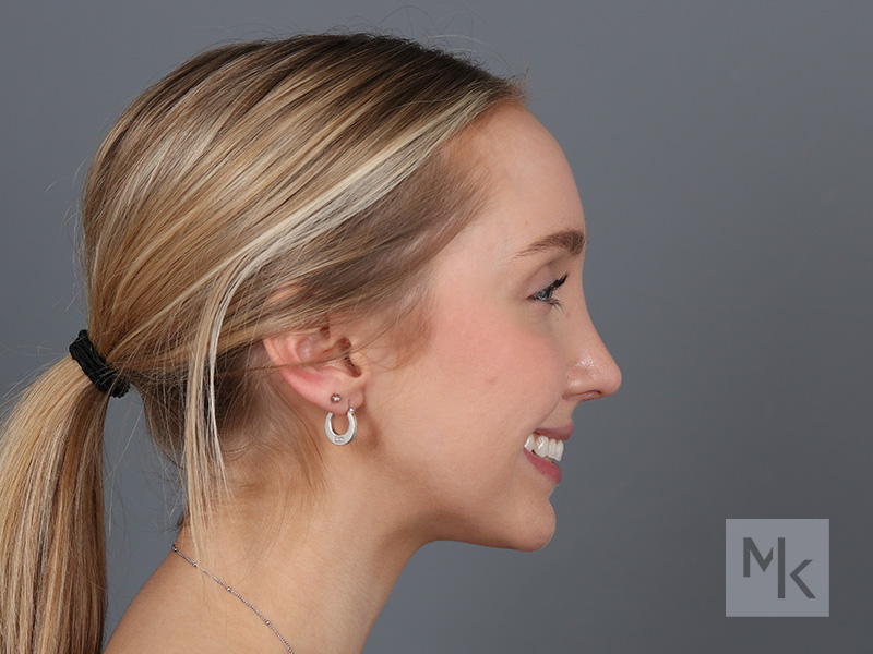 Rhinoplasty Before and After | Dr. Michael Kim