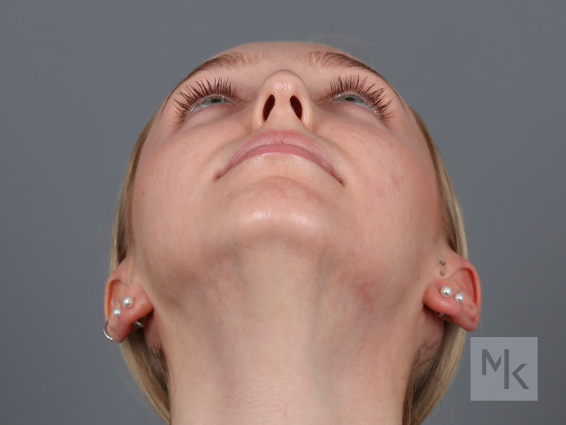 Rhinoplasty Before and After | Dr. Michael Kim