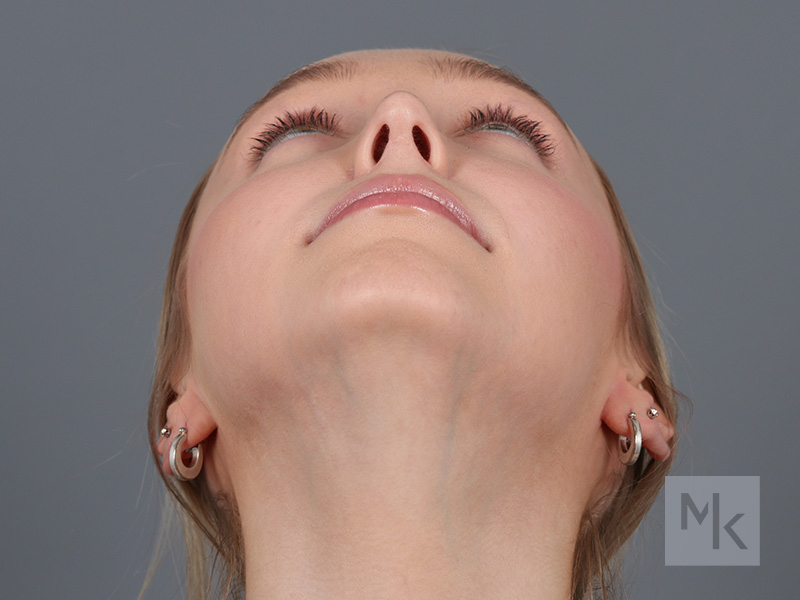 Rhinoplasty Before and After | Dr. Michael Kim