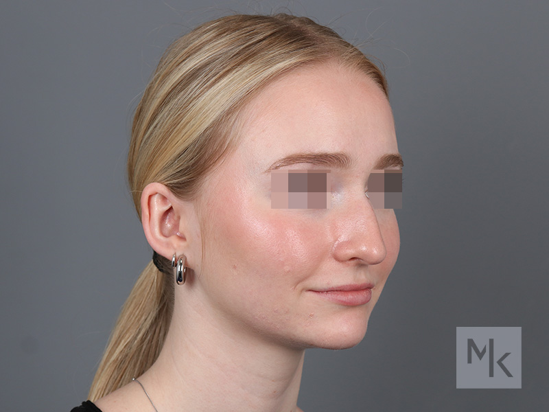 Rhinoplasty Before and After | Dr. Michael Kim