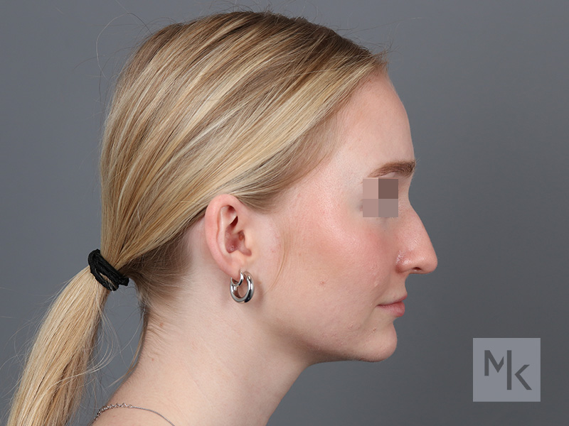 Rhinoplasty Before and After | Dr. Michael Kim