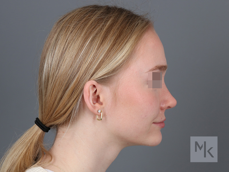 Rhinoplasty Before and After | Dr. Michael Kim