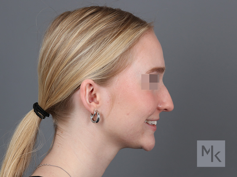 Rhinoplasty Before and After | Dr. Michael Kim