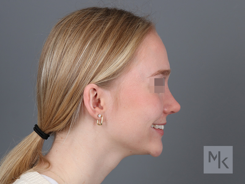 Rhinoplasty Before and After | Dr. Michael Kim