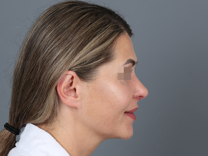 Rhinoplasty Before and After | Dr. Michael Kim