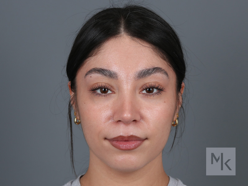 Rhinoplasty Before and After | Dr. Michael Kim