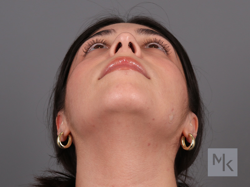 Rhinoplasty Before and After | Dr. Michael Kim