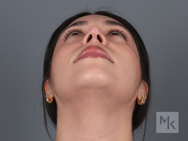 Rhinoplasty Before and After | Dr. Michael Kim