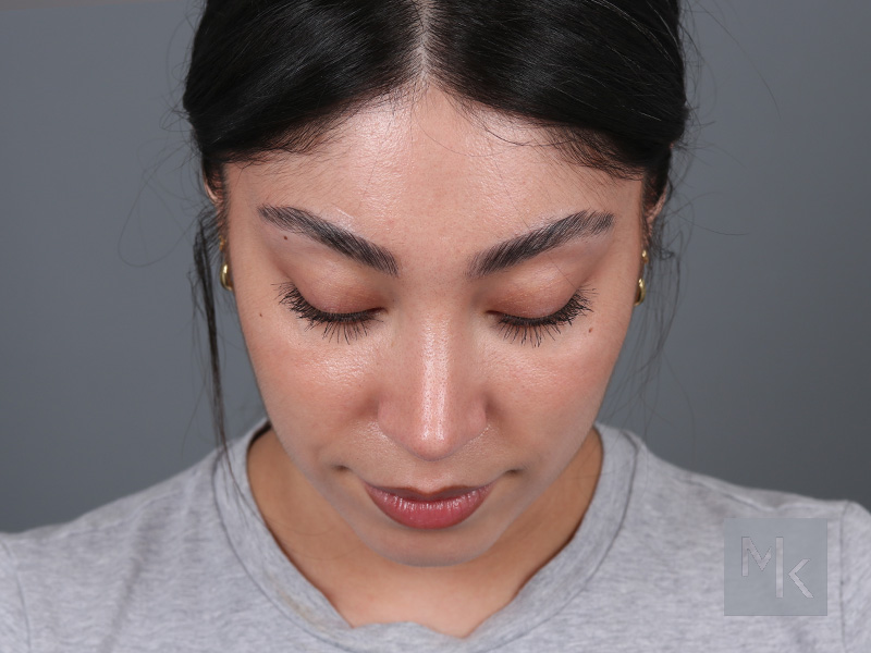 Rhinoplasty Before and After | Dr. Michael Kim