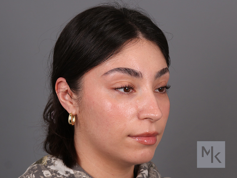 Rhinoplasty Before and After | Dr. Michael Kim