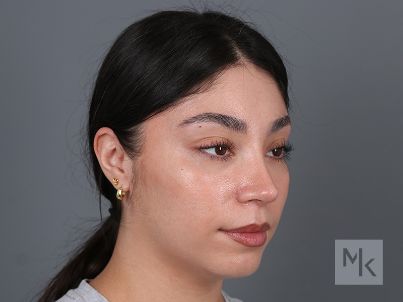 Rhinoplasty Before and After | Dr. Michael Kim