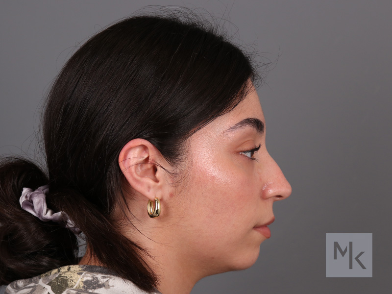 Rhinoplasty Before and After | Dr. Michael Kim