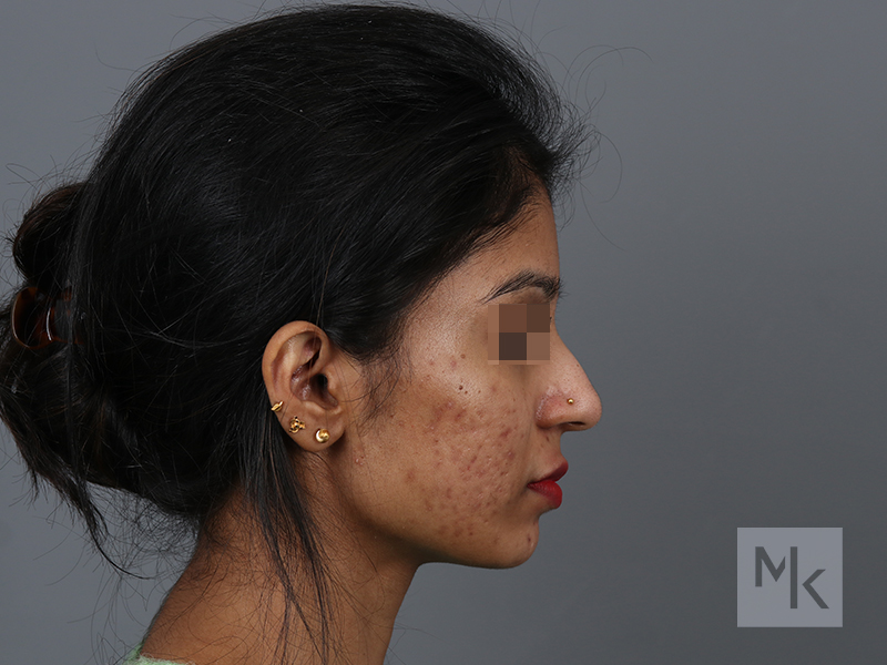 Rhinoplasty Before and After | Dr. Michael Kim