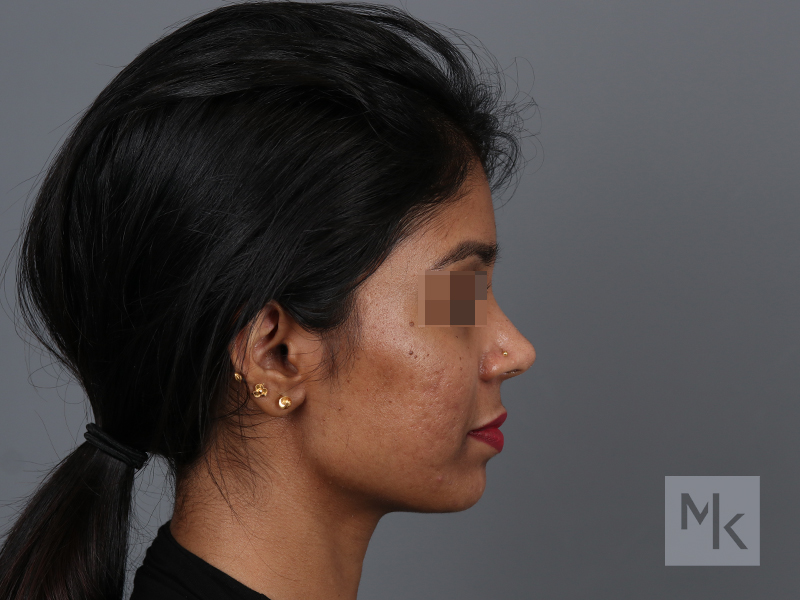 Rhinoplasty Before and After | Dr. Michael Kim