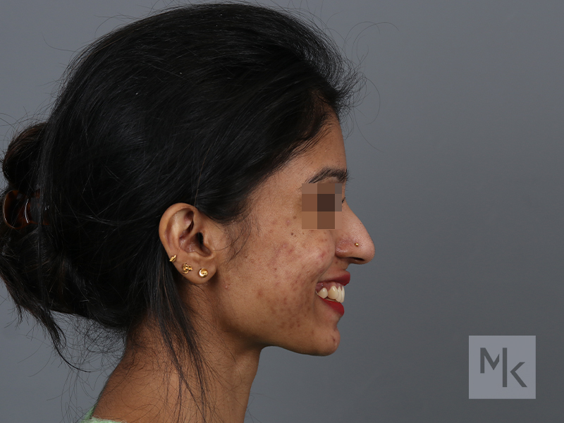 Rhinoplasty Before and After | Dr. Michael Kim