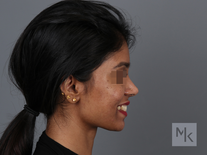 Rhinoplasty Before and After | Dr. Michael Kim