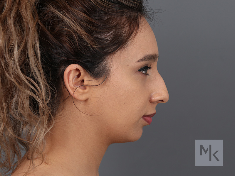 Rhinoplasty Before and After | Dr. Michael Kim