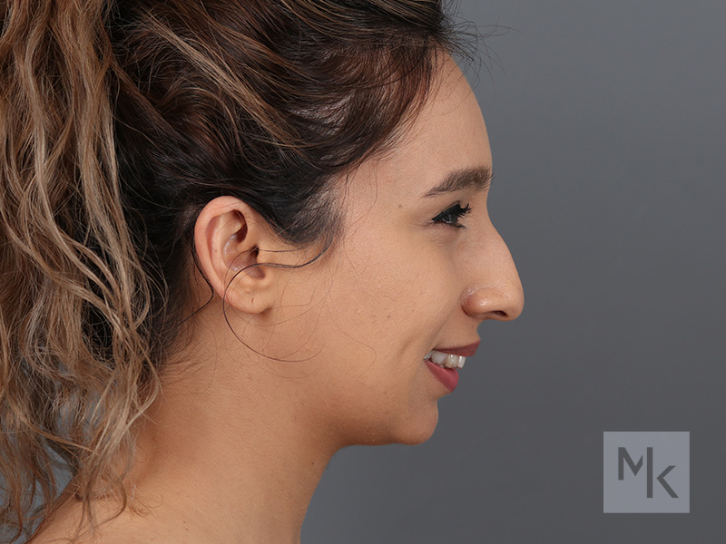 Rhinoplasty Before and After | Dr. Michael Kim