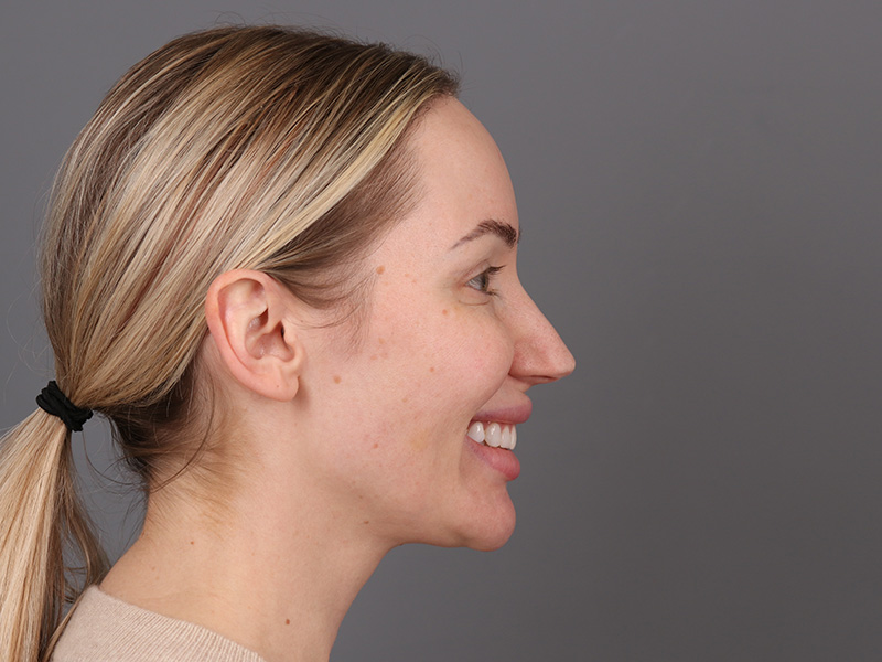 Rhinoplasty Before and After | Dr. Michael Kim