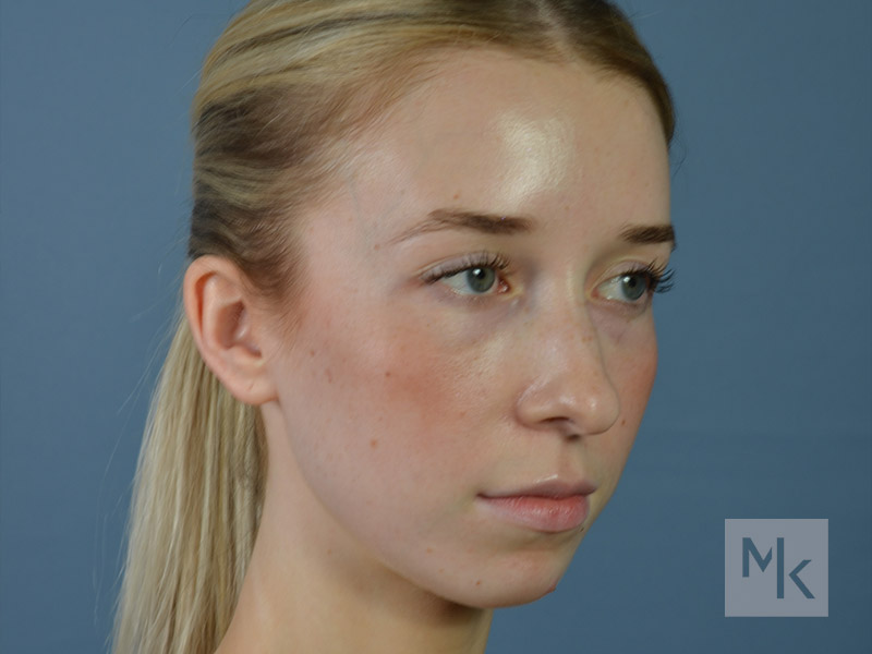 Rhinoplasty Before and After | Dr. Michael Kim