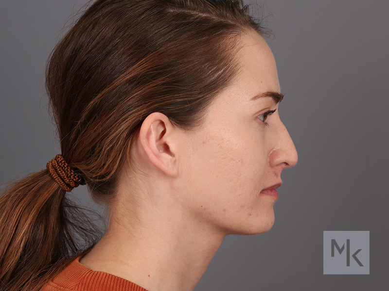 Rhinoplasty Before and After | Dr. Michael Kim