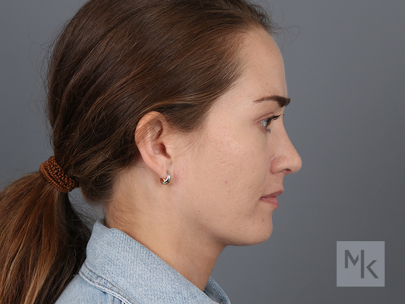 Rhinoplasty Before and After | Dr. Michael Kim