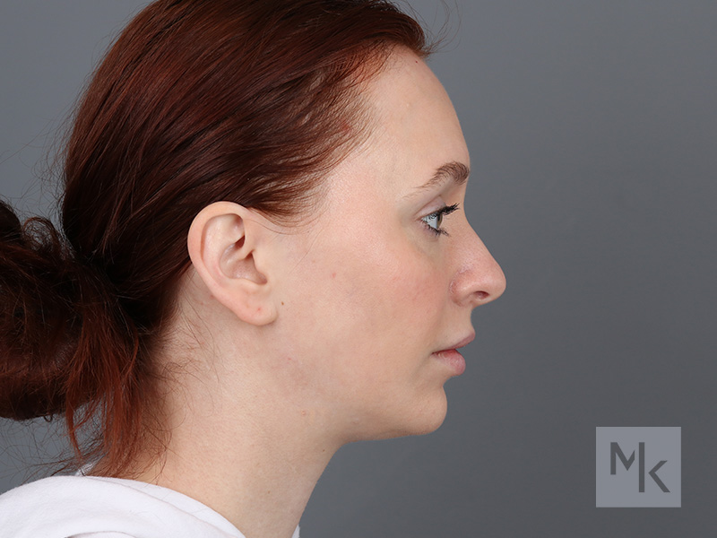 Rhinoplasty Before and After | Dr. Michael Kim